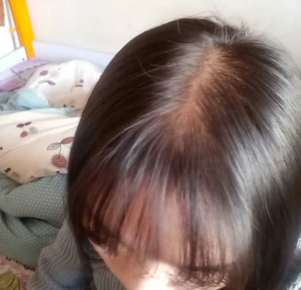 女性脱发的原因 更年期女性由于激素原因易脱发