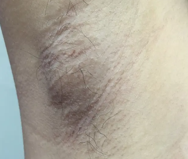 腋窝下有肿块是怎么回事 当心是副乳