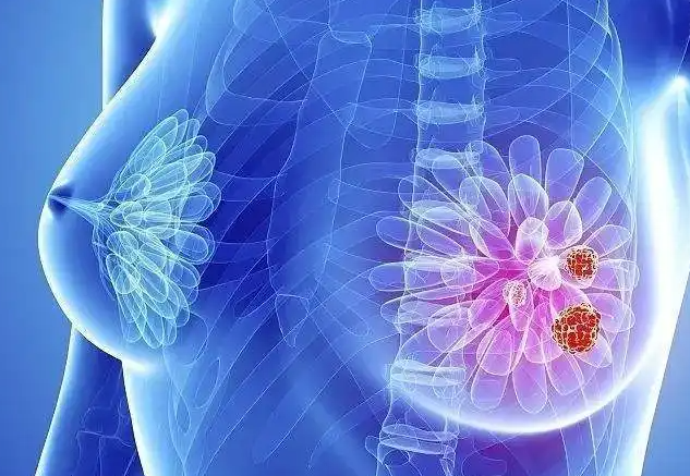 乳腺增生症状如何早发现 根据经期乳房的两大症状决定