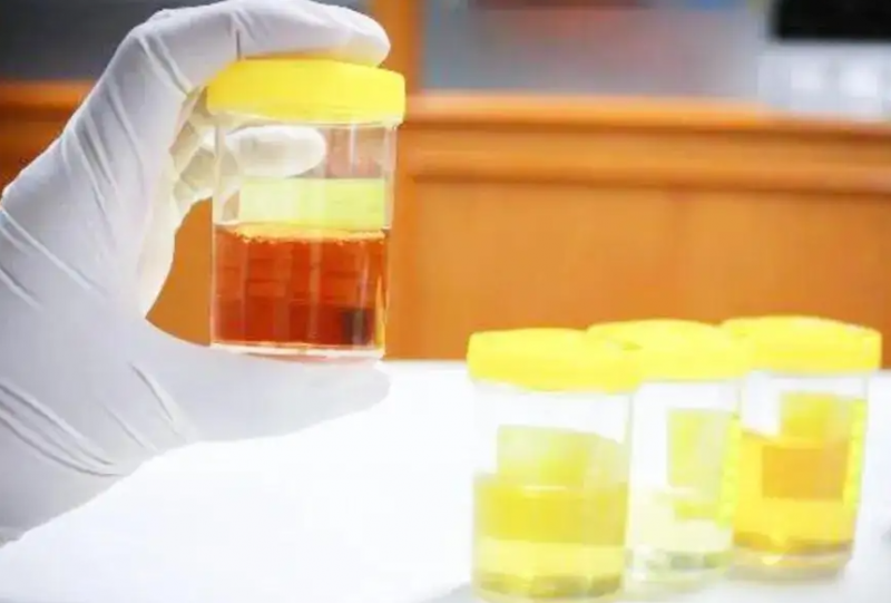 尿酸高不能吃什么食物 尿酸高什么水果不能吃