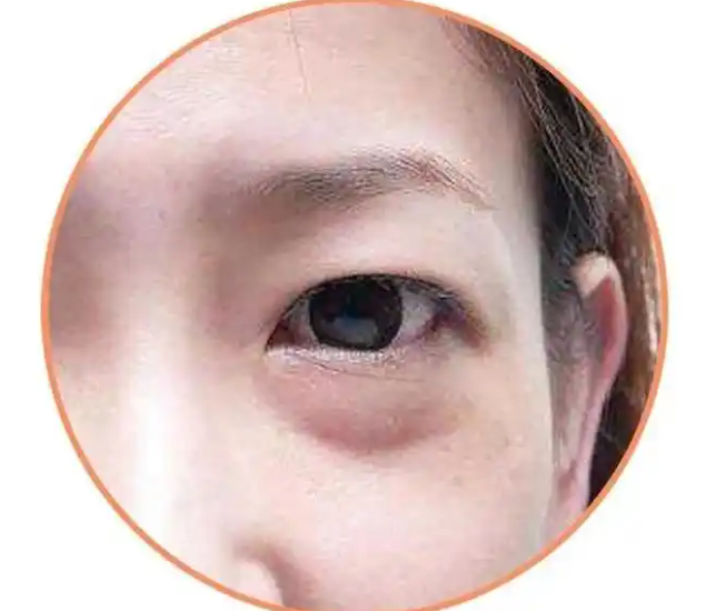 熬夜眼袋能自己恢复吗 熬夜眼袋多久可以恢复