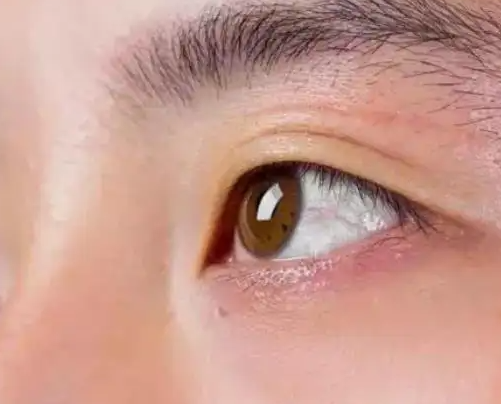 眼皮抽搐是怎么回事儿 眼皮一直抽搐怎么办