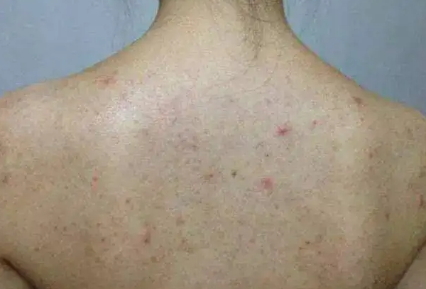 女生后背长痘痘是什么原因 为什么女生后背长痘