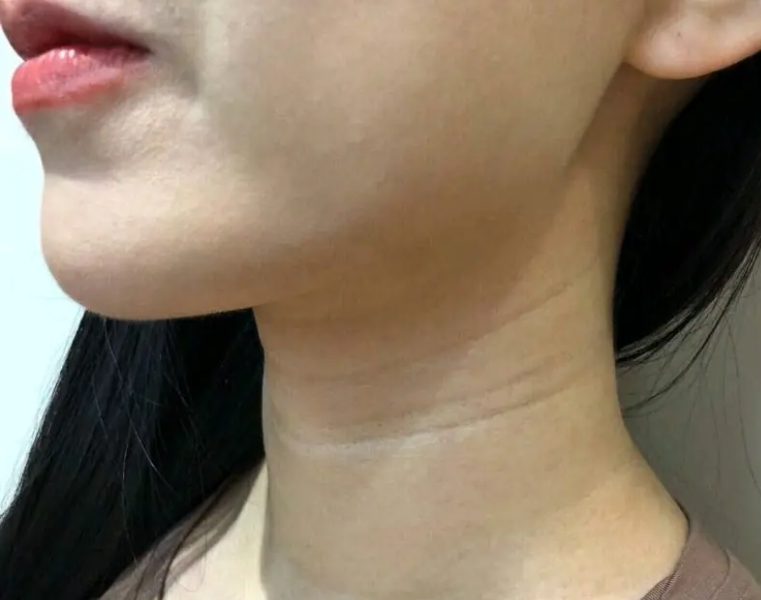 脖子的颈纹如何消除 如何正确消除颈纹