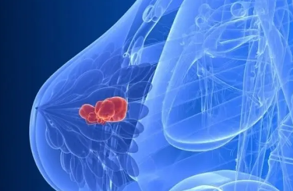 治乳腺增生的偏方有哪些 治疗乳腺增生的偏方大全