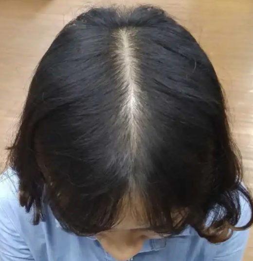 女性会脱发吗 职业女性也会患男性脱发的