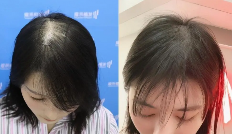 女性脱发的主要原因有哪些 揭秘女性脱发3大元凶