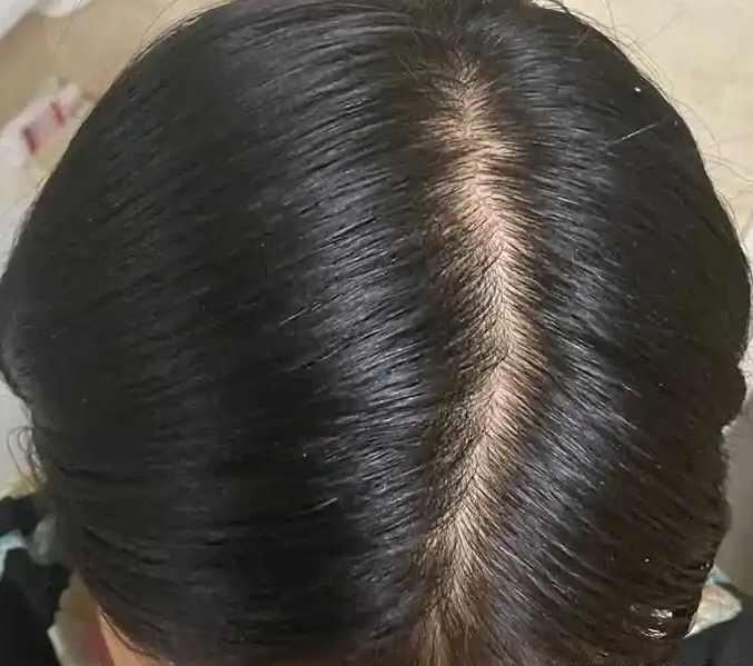 秋季掉发是怎么回事 每日超百根可能是脱发