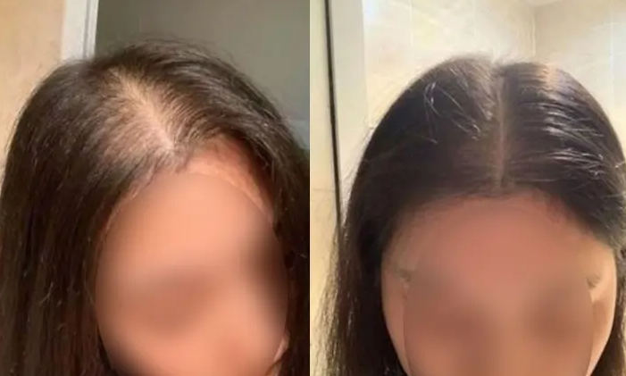 孕妇产后大量脱发怎么办 积极预防是关键