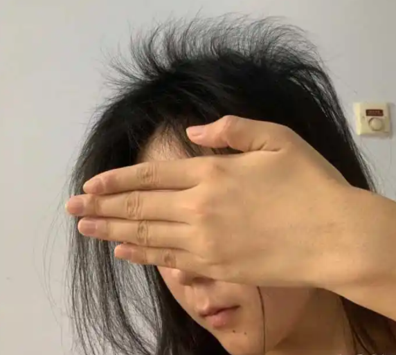 女人产后脱发的原因主要是什么 雌激素水平变化是关键因素