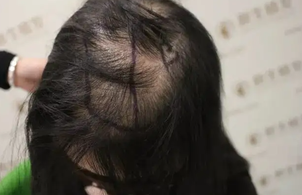 怎么预防产后脱发 洗净残液是产后脱发预防的关键