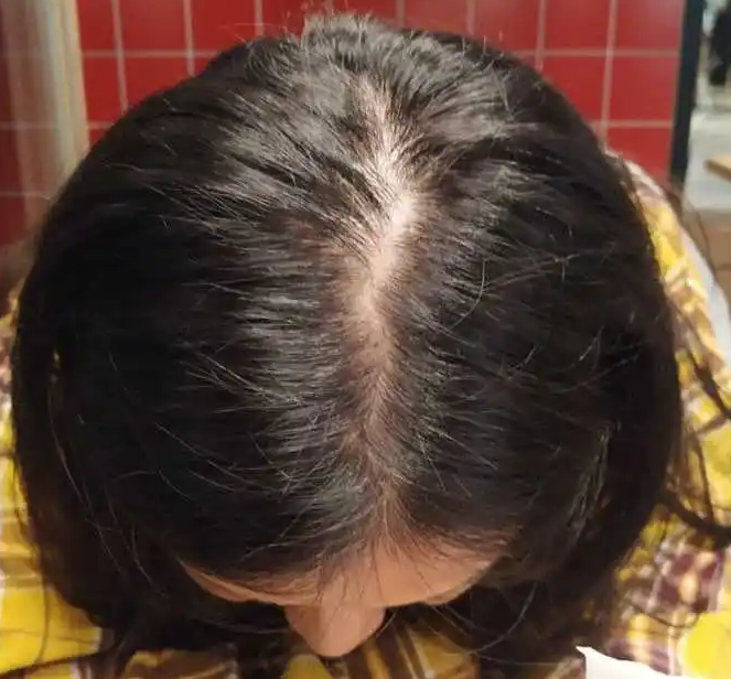产后脱发需注意事项 产后脱发4大注意事项