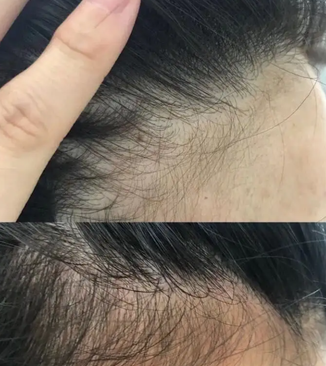 产后脱发怎么办 做好预防和护理脱发的措施