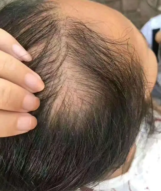 如何预防产后脱发 合理膳食加强营养