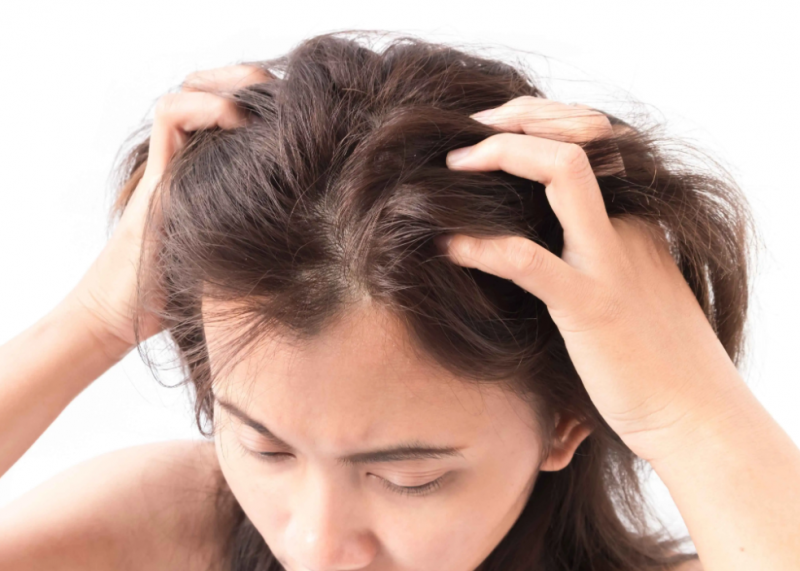 女性脱发怎么办 女性型脱发常见护理方法