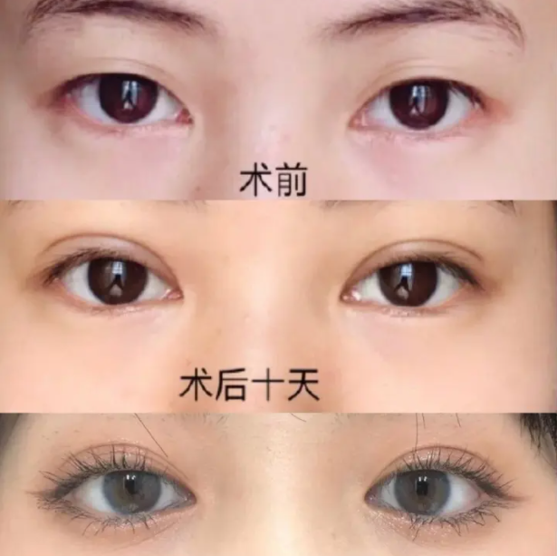 抽脂双眼皮的效果好不好 你一定要了解