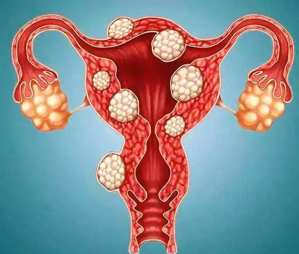 子宫肌瘤对身体有影响吗 女子因子宫肌瘤导致肚大似怀孕