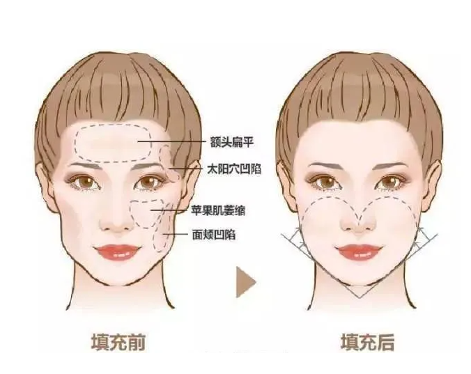 太阳穴痛是什么引起的 太阳穴痛怎么办