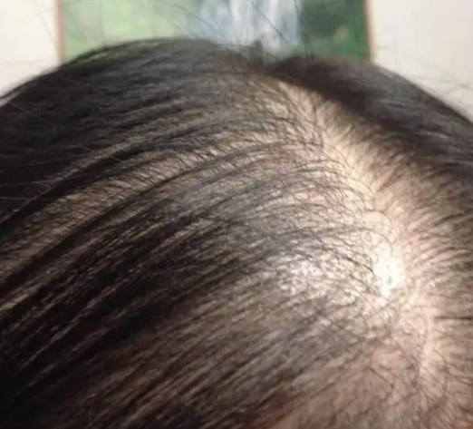 女性脱发是为什么  女性离婚后更易脱发