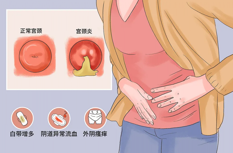 如何预防宫颈糜烂复发 这些预防措施不可松懈