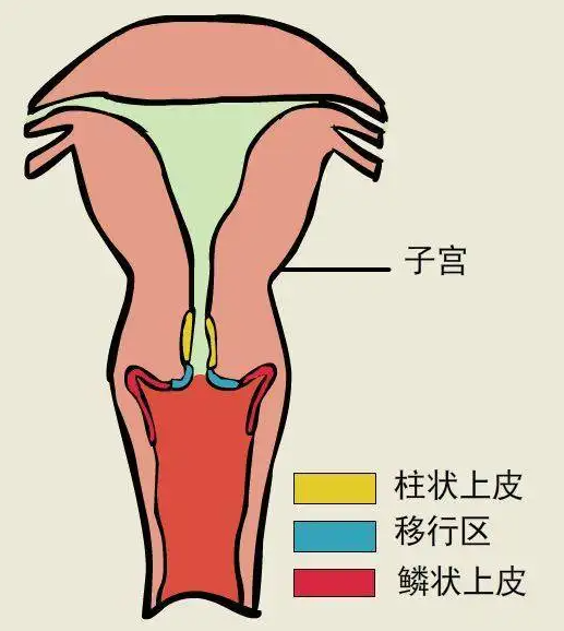 宫颈糜烂有哪些类型 详述不同类型对应的症状