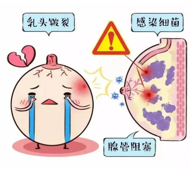 如何用远志治疗急性乳腺炎 两个远志单方推荐