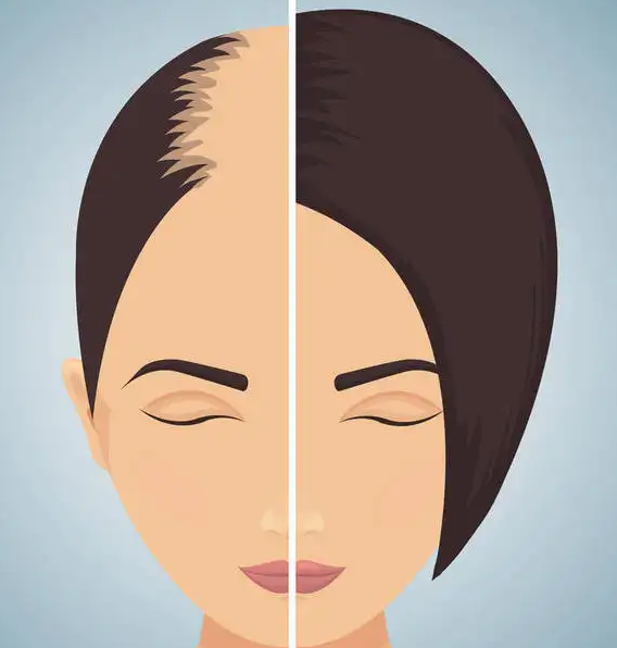 什么才是最主要的引起女性脱发的原因 专家讲解女性脱发原因