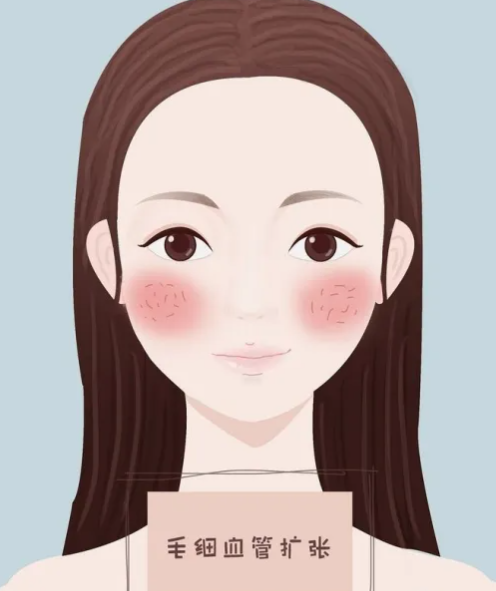 脸上的红血丝是怎么回事？又应该如何改善去除红血丝？