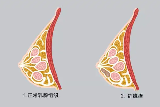 做乳腺纖維瘤手術好後悔,還好遇到了它