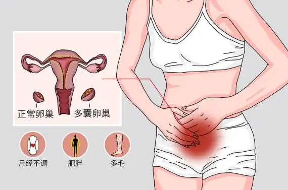 多囊卵巢综合症吃什么食物好