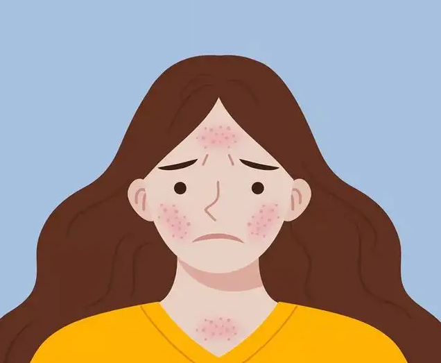成人得了湿疹怎么办？大人得了湿疹怎么治效果好