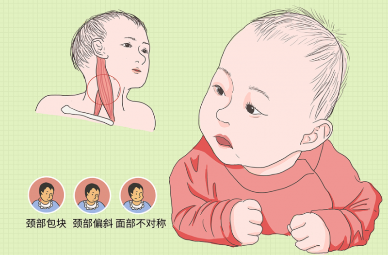婴儿斜颈有哪些危害