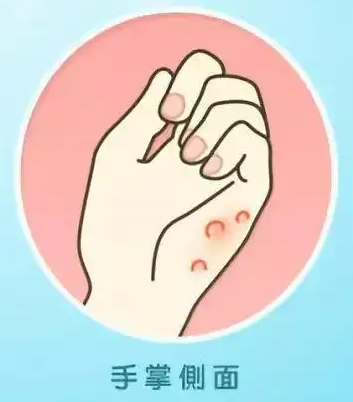 手上起小水泡很痒怎么回事