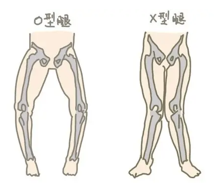 宝宝出现罗圈腿怎么办呢？