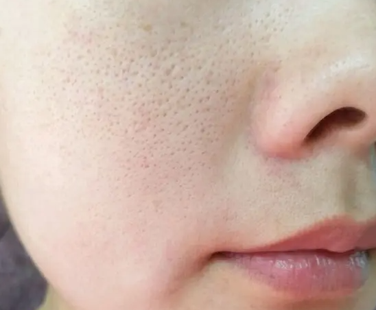 女人毛孔粗大怎么办  教你收缩毛孔的方法