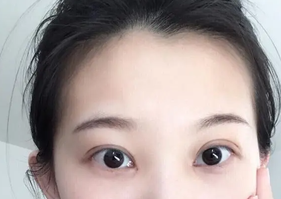 切双眼皮要花多少钱  切双眼皮后护理方法细解