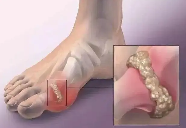 饮酒适度也可以防风湿性关节炎