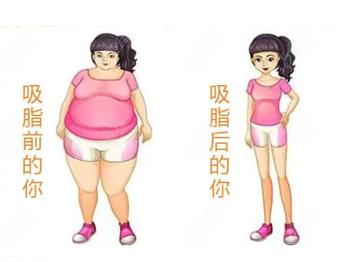 产后多久可以做吸脂