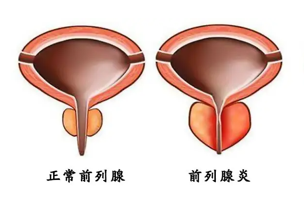 前列腺炎怎么治疗 苹果缓解前列腺炎
