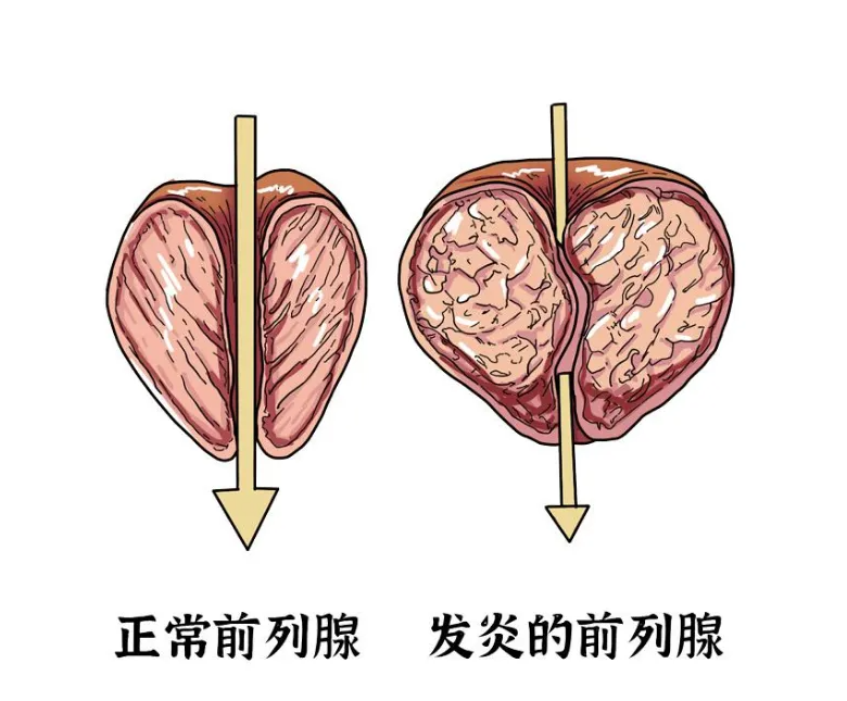 前列腺炎都有哪些食疗方法？