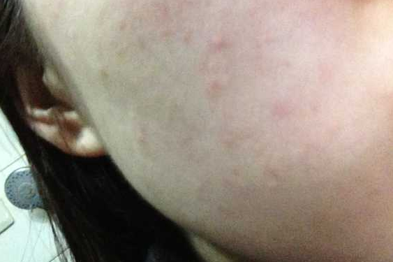 面部皮肤过敏自救方法