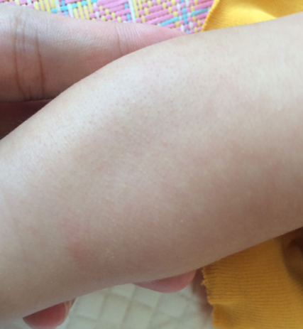 婴儿腿上皮肤粗糙像藓怎么回事