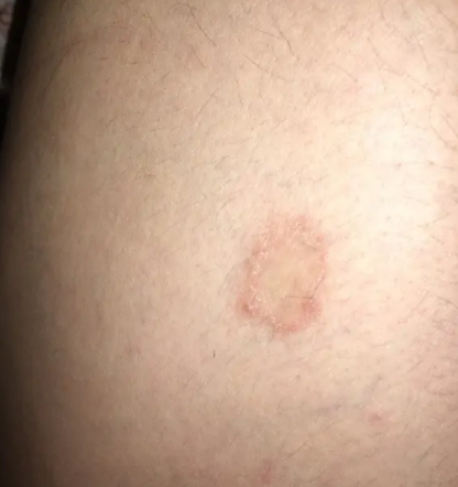腿部皮肤粗糙毛孔大怎么改善