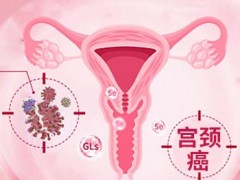 宫颈癌最爱的7类女性 吃单糖人参皂苷rh2可调理