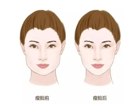 瘦脸针打完会肿吗