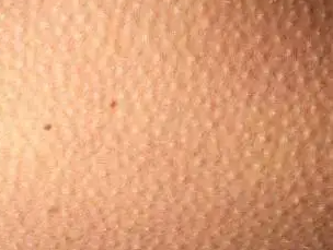 鸡皮肤能脱毛吗