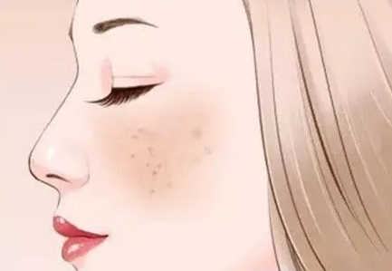 斑形成的原因