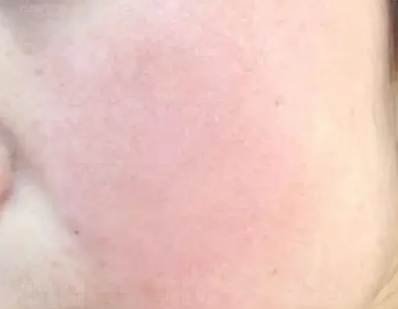 脸上皮肤有红血丝怎么办