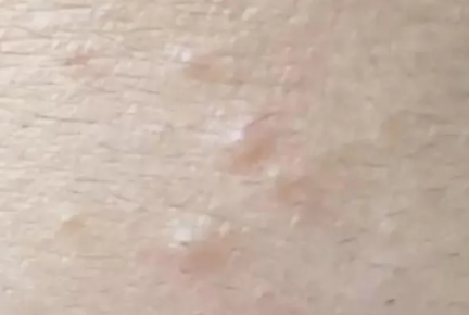 什么是白头粉刺(白头痘痘是怎么形成的)