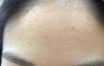 额头和嘴角长痘什么原因引起(为什么额头和嘴角长痘)